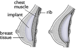 Breast enlargement